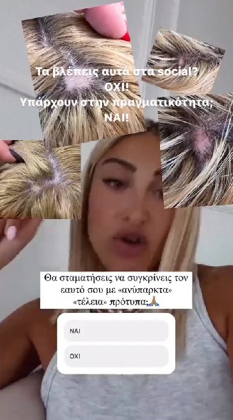 Η Ιωάννα Τούνη αποκαλύπτει το αυτοάνοσο νόσημα που την ταλαιπωρεί & μοιράζεται τις φωτογραφίες