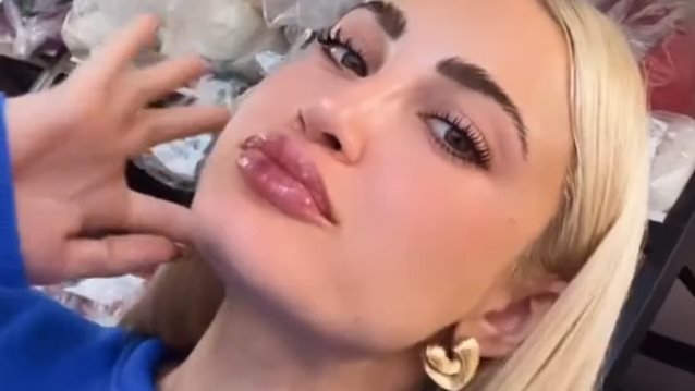 To παράκανε η Ιωάννα Τούνη με το υαλουρονικό: To ξέρω ότι φαίνομαι σαν πάπια