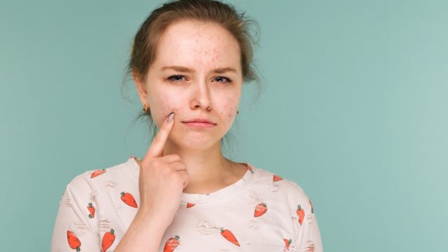 Επηρεάζει το στρες την ακμή στους εφήβους;