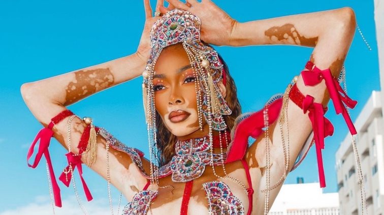 Winnie Harlow | &#39;Εγινε η &quot;βασίλισσα του Καρναβαλιού&quot; στην Τζαμάικα